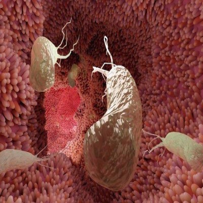 درمان ساده‌ای که می‌تواند از 75 درصد سرطان‌های معده جلوگیری کند