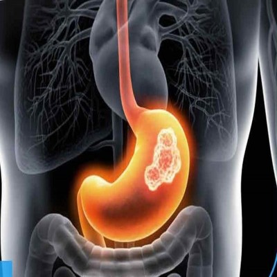سرطان‌‌های معده و روده بزرگ شایع‌ترین انواع سرطان