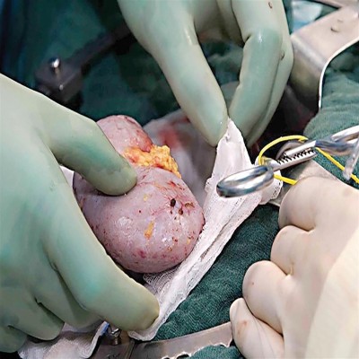 ایران، همتراز جهان در پیوند کلیه