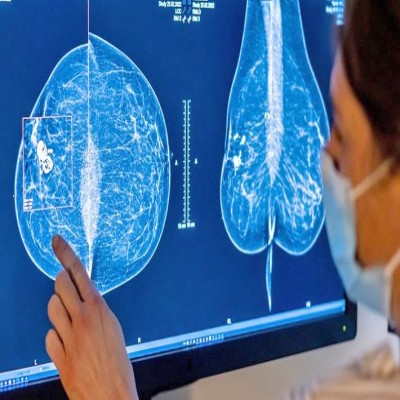 خودارزیابی ماهانه؛ کلیدی‌ترین اقدام پیشگیرانه در سرطان سینه